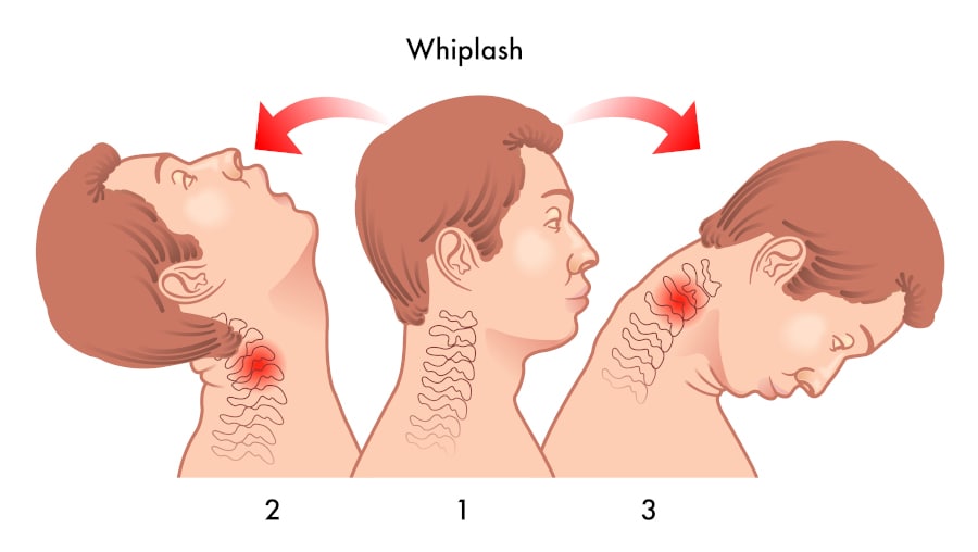 Demonstration of positions of the neck during a whiplash event.
